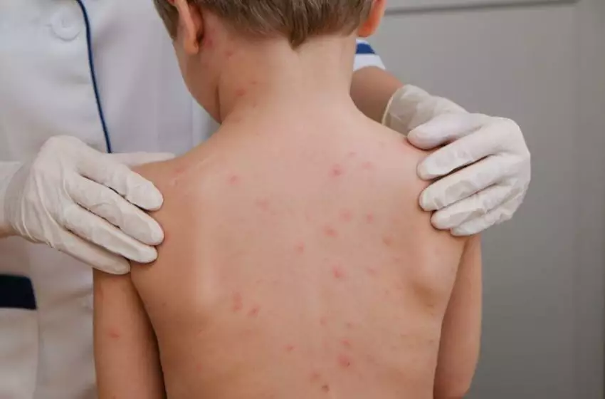 Centro Estadual de Vigilância em Saúde emite alerta epidemiológico para surto de meningite no Sul do RS