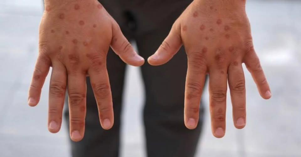 Porto Alegre registra primeiro caso de Mpox em 2026