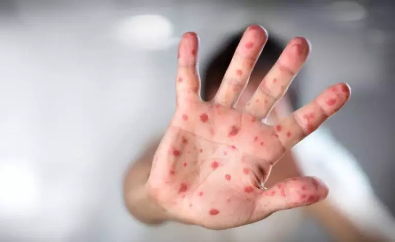 Casos de sarampo em outros Estados reforçam alerta no Rio Grande do Sul